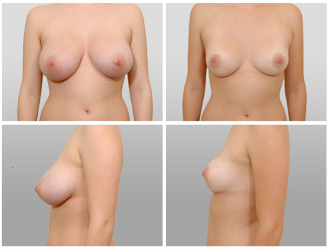 уменьшение груди до и после
