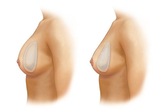 увеличение груди имплантами