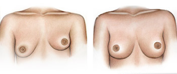 асимметрия груди